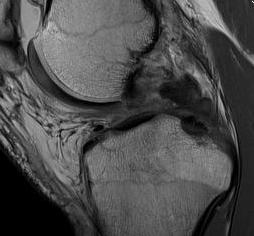 PCL femoral avulsion MRI